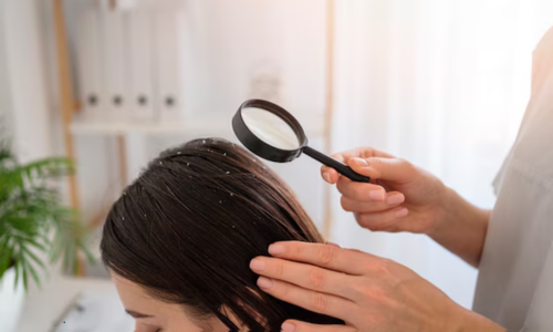 Dandruff Treatment in Dubai Using Homeopathy