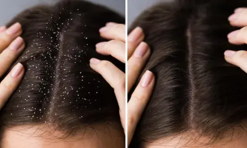 Best Homeopathy Dandruff Treatment in Dubai for Long-Term Scalp Health & Relief